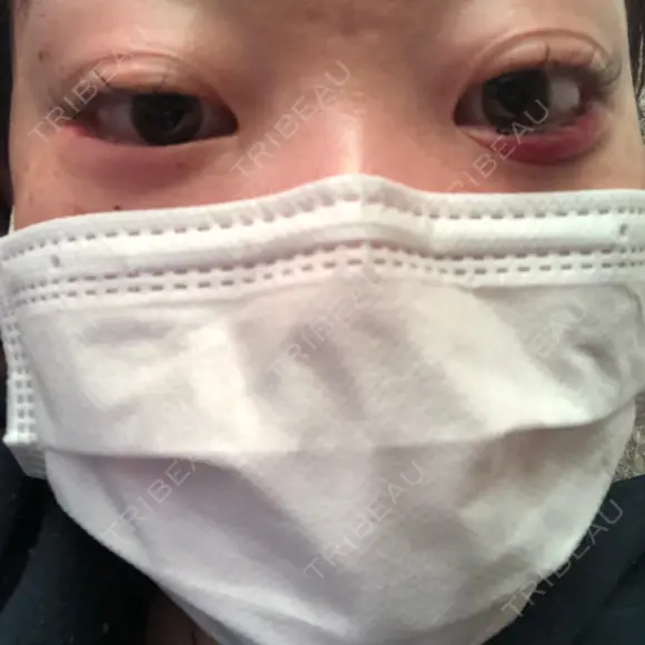 その他（目元） コムロクリニック 東京銀座院 DAY 1 メイン用