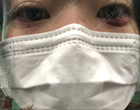 その他（目元） コムロクリニック 東京銀座院 DAY 1 メイン用