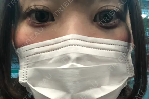 その他（目元） コムロクリニック 東京銀座院 DAY 2 メイン用