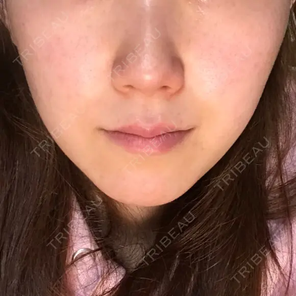 脂肪溶解注射（顔） / その他（肌） The-Clim産婦人科  DAY 17 メイン用