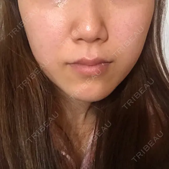 脂肪溶解注射（顔） / その他（肌） The-Clim産婦人科  DAY 20 メイン用