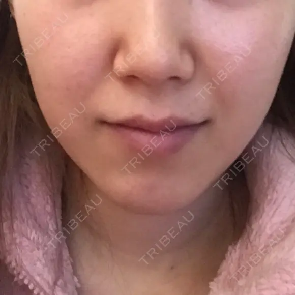 脂肪溶解注射（顔） / その他（肌） The-Clim産婦人科  DAY 23 メイン用