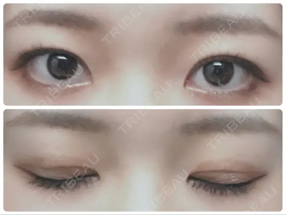 二重埋没 城本クリニック 姫路院 DAY 16 メイン用