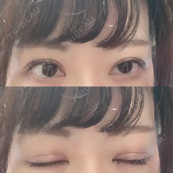 眼瞼下垂（切開） 札幌中央形成外科 DAY 48 メイン用