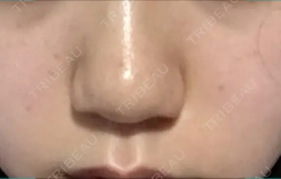 スレッドノーズ リエンジャン整形外科 江南店 DAY 9 メイン用