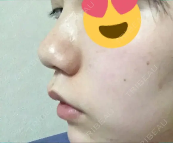 スレッドノーズ リエンジャン整形外科 江南店 DAY 10 メイン用