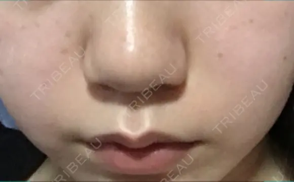 スレッドノーズ リエンジャン整形外科 江南店 DAY 10 メイン用