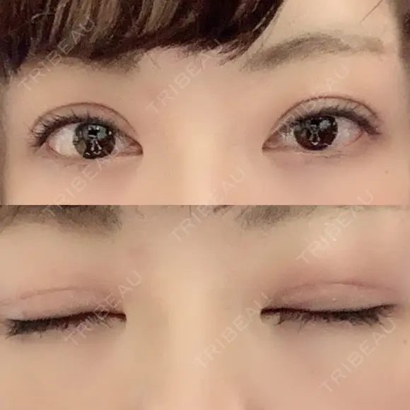 眼瞼下垂（切開） 札幌中央形成外科 DAY 49 メイン用