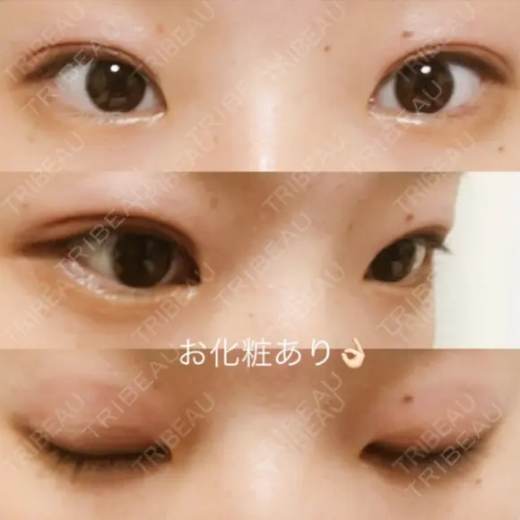 二重埋没 湘南美容クリニック 大阪堺東院 DAY 22 メイン用