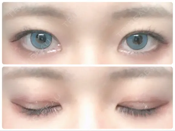 二重埋没 城本クリニック 姫路院 AFTER メイン用