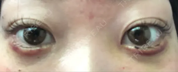 その他（目元） コムロクリニック 東京銀座院 DAY 4 メイン用