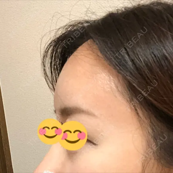 額を丸く / 脂肪注入（額） / 再生医療 / PRP皮膚再生療法 エートップ美容整形外科 AFTER メイン用