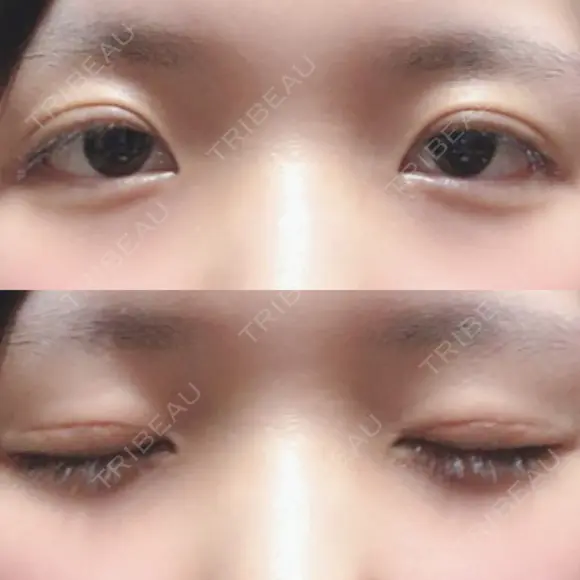 二重切開 / 上まぶたの脂肪取り 城本クリニック 長崎院 DAY 29 メイン用