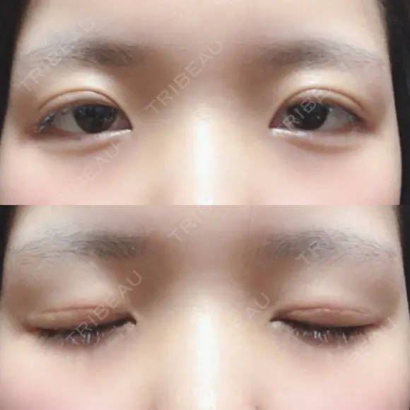 二重切開 / 上まぶたの脂肪取り 城本クリニック 長崎院 DAY 30 メイン用