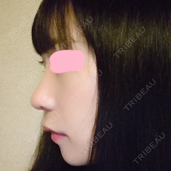 鼻尖形成（切開） / 小鼻縮小（切開） / 軟骨移植 / 骨切幅寄せ HANABI整形外科 DAY 51 メイン用