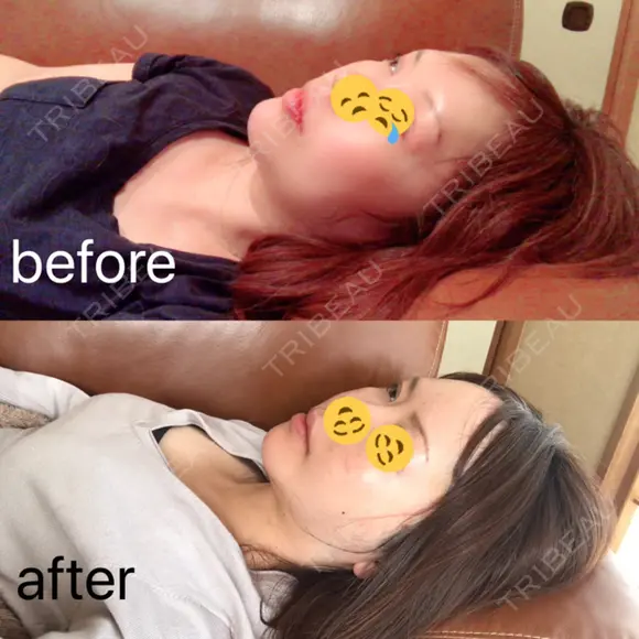 糸リフト / 骨切り（あご） / 骨削り（エラ） / 骨削り（頬） / 脂肪吸引（顔） / 輪郭修正 / 脂肪注入（額） / 脂肪注入（輪郭） / ハイフ（顔） GIRIN（ギリン）美容外科 DAY 37 メイン用