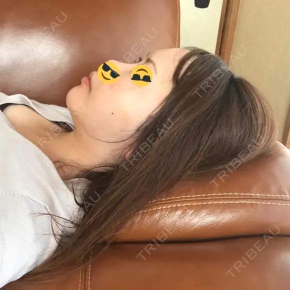 糸リフト / 骨切り（あご） / 骨削り（エラ） / 骨削り（頬） / 脂肪吸引（顔） / 輪郭修正 / 脂肪注入（額） / 脂肪注入（輪郭） / ハイフ（顔） GIRIN（ギリン）美容外科 DAY 37 メイン用