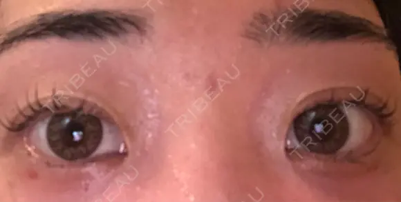 その他（目元） コムロクリニック 東京銀座院 DAY 9 メイン用