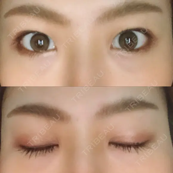 二重埋没 藤・ナチュレ美容クリニック 恵比寿院 AFTER メイン用