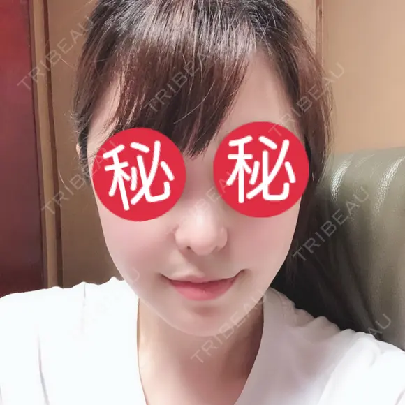 鼻中隔延長（切開） / 骨切り（あご） / 骨削り（エラ） / 軟骨移植 / 眉間プロテーゼ id（アイディ）美容外科 AFTER メイン用