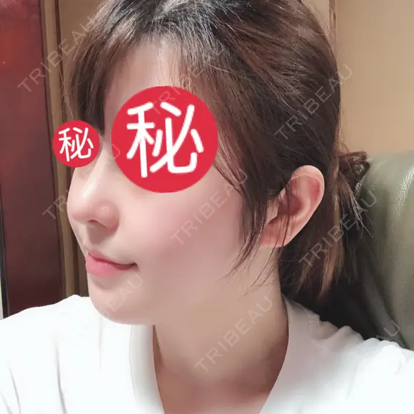 鼻中隔延長（切開） / 骨切り（あご） / 骨削り（エラ） / 軟骨移植 / 眉間プロテーゼ id（アイディ）美容外科 DAY 143 メイン用