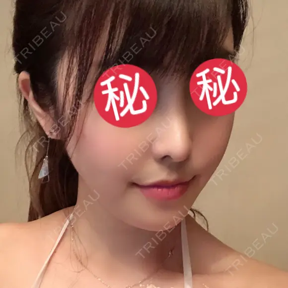 鼻中隔延長（切開） / 骨切り（あご） / 骨削り（エラ） / 軟骨移植 / 眉間プロテーゼ id（アイディ）美容外科 DAY 143 メイン用