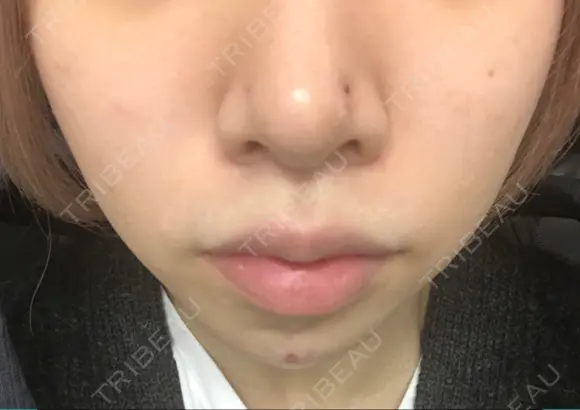 鼻尖形成（切開） / ヒアルロン酸注入（あご） TCB東京中央美容外科 世田谷院 DAY 4 メイン用