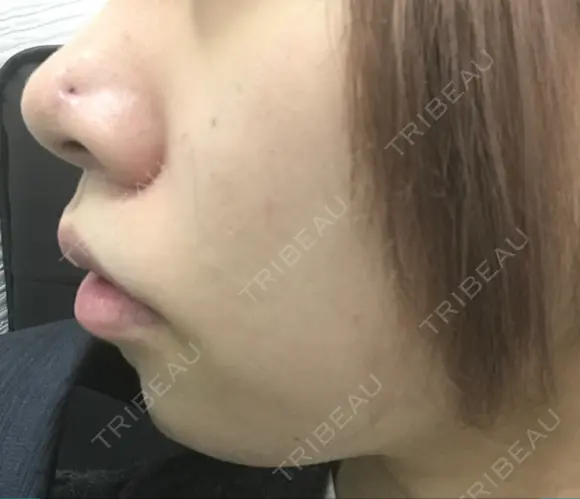 鼻尖形成（切開） / ヒアルロン酸注入（あご） TCB東京中央美容外科 世田谷院 DAY 4 メイン用