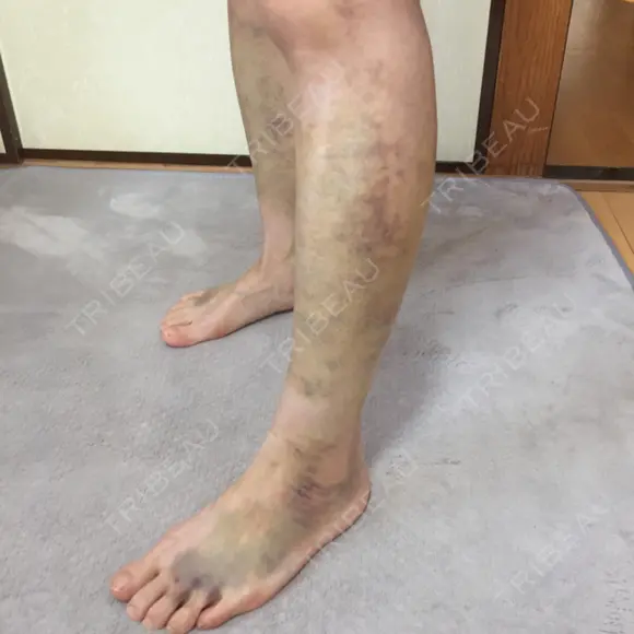 脂肪吸引（脚） / 肌ヒアルロン酸注入（たるみ・シワ改善） プチパーティー医院 DAY 18 メイン用