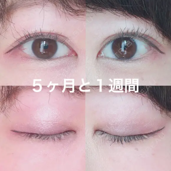 二重埋没 / 目頭切開 かめい美容クリニック宇都宮 DAY 159 メイン用