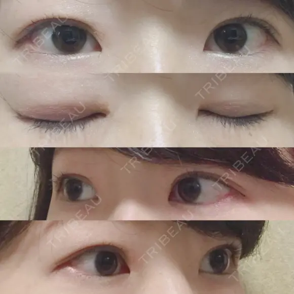 二重埋没 / 目頭切開 かめい美容クリニック宇都宮 DAY 431 メイン用