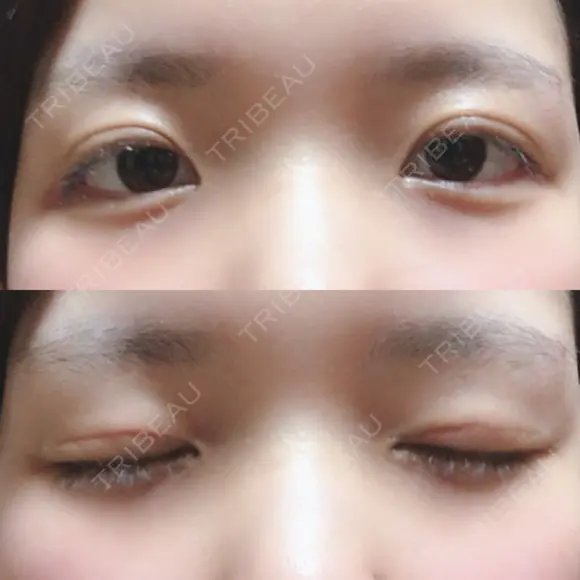 二重切開 / 上まぶたの脂肪取り 城本クリニック 長崎院 DAY 33 メイン用