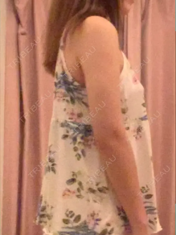 脂肪吸引（二の腕） プチパーティー医院 DAY 39 メイン用