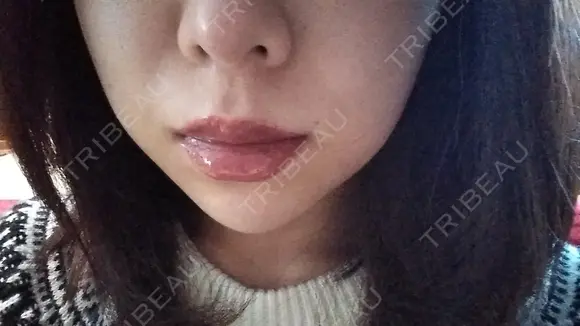 ヒアルロン酸注入（頬） LE CLINIC DAY 19 メイン用