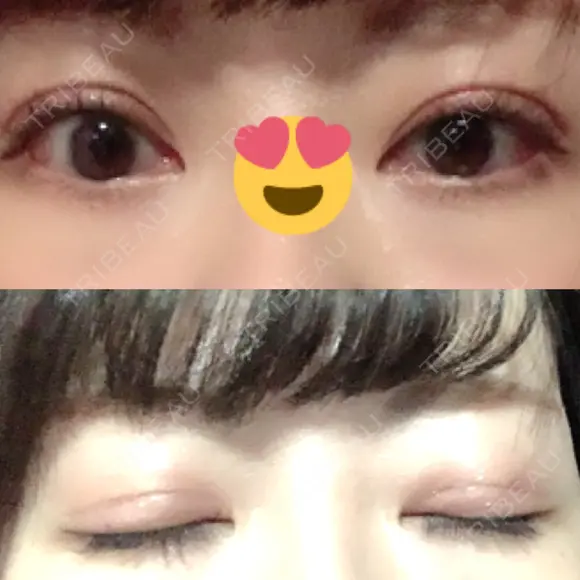 眼瞼下垂（切開） 札幌中央形成外科 AFTER メイン用