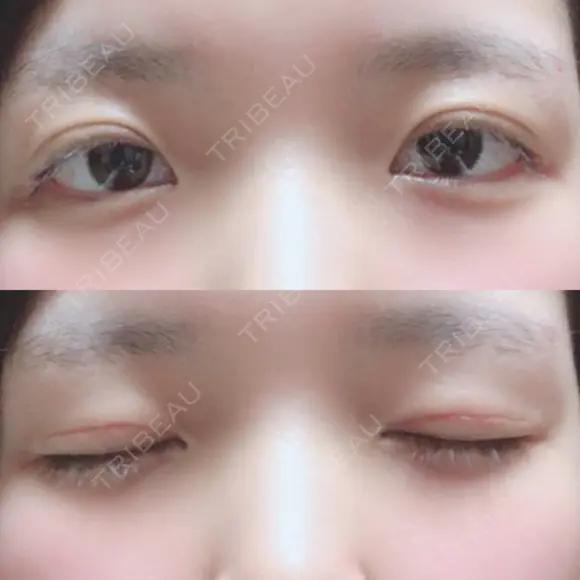 二重切開 / 上まぶたの脂肪取り 城本クリニック 長崎院 DAY 34 メイン用