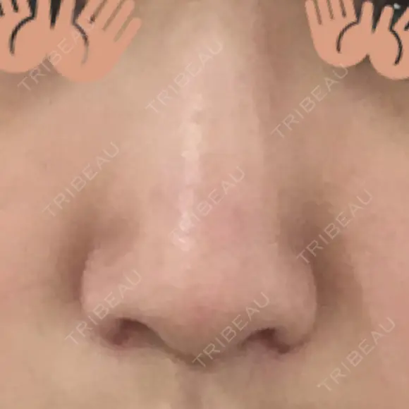 小鼻縮小（切開） 東京ヒルズクリニック 新宿院 DAY 40 メイン用