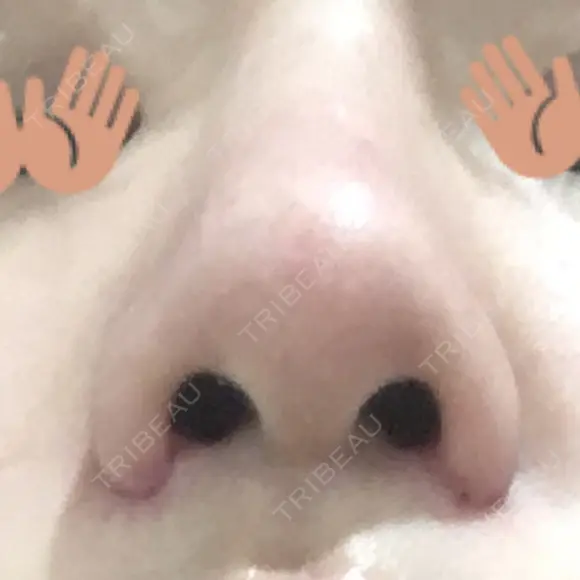 小鼻縮小（切開） 東京ヒルズクリニック 新宿院 DAY 40 メイン用