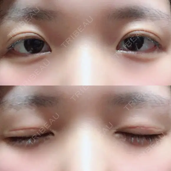 二重切開 / 上まぶたの脂肪取り 城本クリニック 長崎院 DAY 35 メイン用