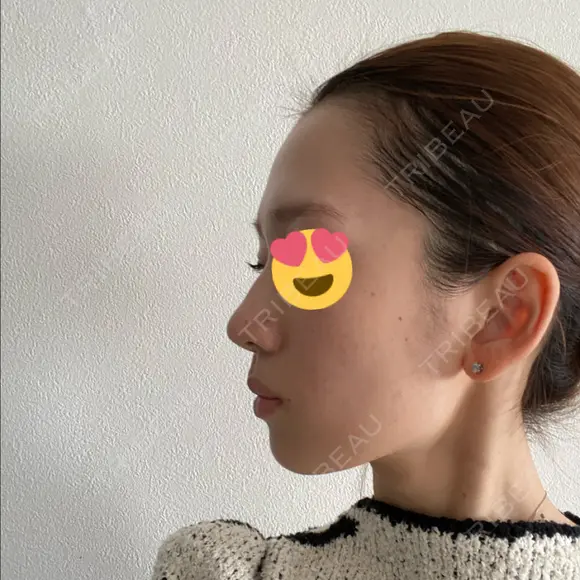 小鼻縮小（切開） / 糸リフト / 鼻尖縮小 / ヒアルロン酸注入（鼻） / ハイフ（顔） ヴェリテクリニック 大阪院 DAY 163 メイン用