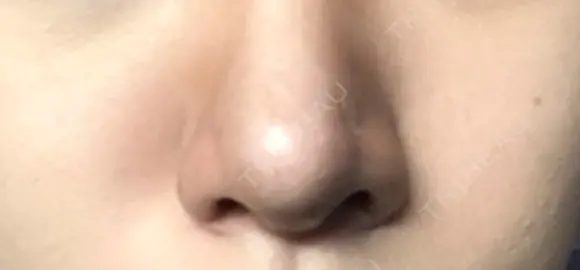 鼻尖形成（切開） / ヒアルロン酸注入（あご） TCB東京中央美容外科 世田谷院 DAY 8 メイン用