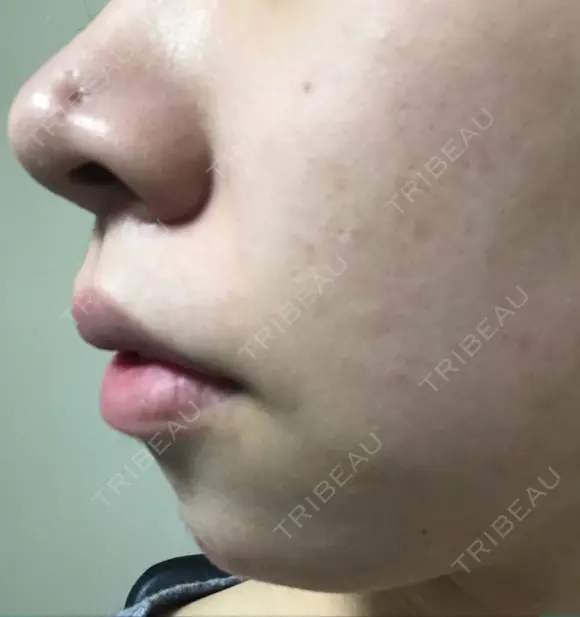 鼻尖形成（切開） / ヒアルロン酸注入（あご） TCB東京中央美容外科 世田谷院 DAY 9 メイン用