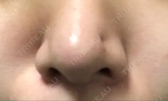 鼻尖形成（切開） / ヒアルロン酸注入（あご） TCB東京中央美容外科 世田谷院 DAY 9 メイン用