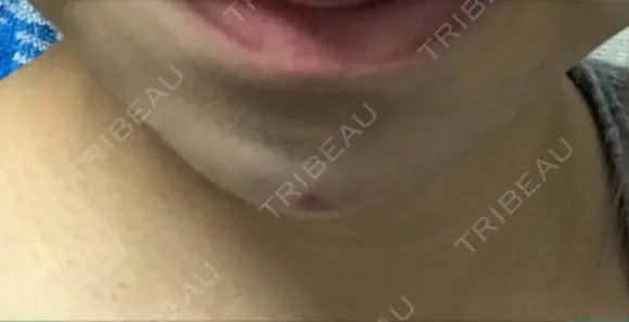 鼻尖形成（切開） / ヒアルロン酸注入（あご） TCB東京中央美容外科 世田谷院 DAY 9 メイン用