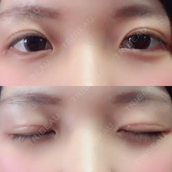二重切開 / 上まぶたの脂肪取り 城本クリニック 長崎院 AFTER メイン用