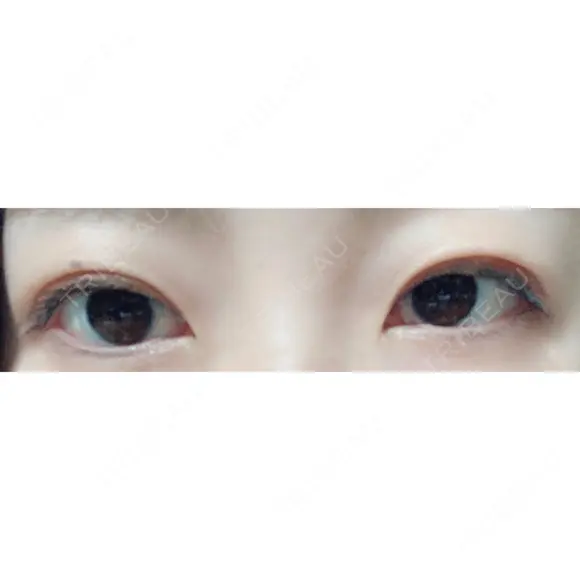 二重埋没 城本クリニック 姫路院 AFTER メイン用