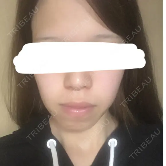 糸リフト / バッカルファット除去 / ボトックス（エラ・小顔） 湘南美容クリニック 静岡院 AFTER メイン用