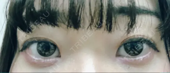 その他（目元） コムロクリニック 東京銀座院 AFTER メイン用