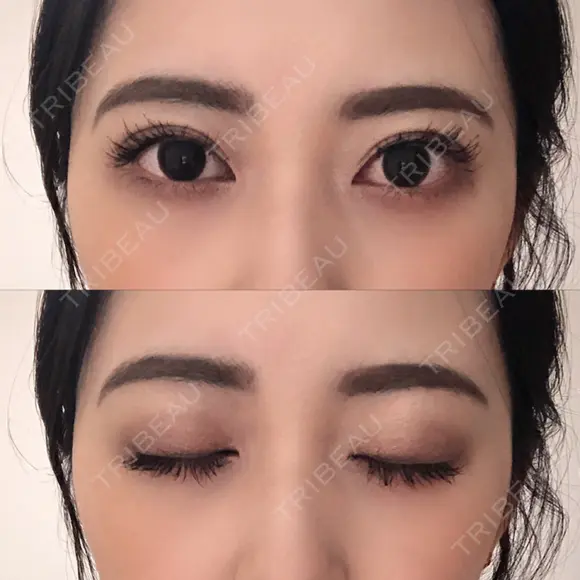 二重切開 ルネッサンス美容外科医院 神戸院 DAY 271 メイン用