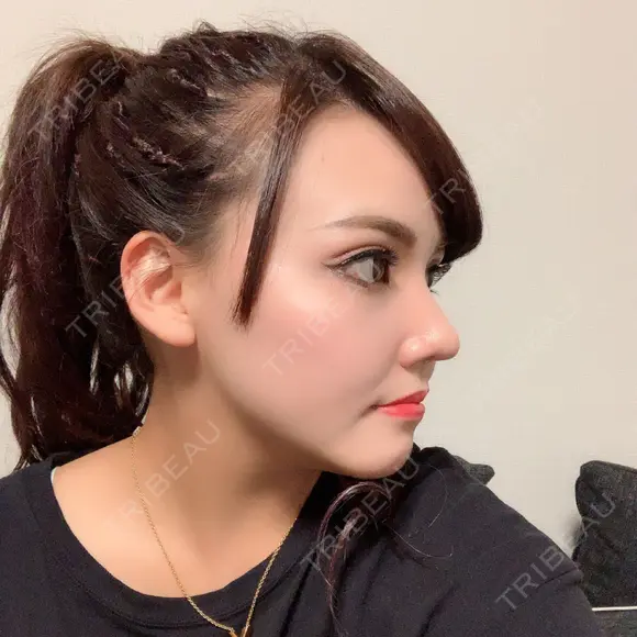 二重切開 / 目頭切開 / 眼瞼下垂（切開） / 軟骨移植 / 骨切幅寄せ / 斜鼻修正 id（アイディ）美容外科 DAY 33 メイン用